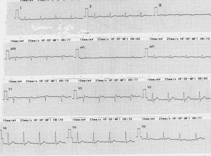 Man, 40 yrs, syncope during