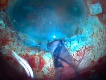 inside the eye because younger donor tissue tends to curl up tightly.