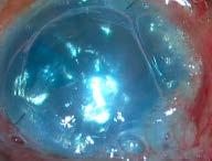 approximately 35 microns graft from the donor corneas of both adults and