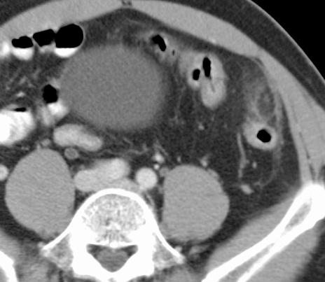 Described the CT Appearance of Epiploic Appendagitis Paracolic 1-4 cm oval fat density surrounded by inflammatory fat stranding Inflammation is