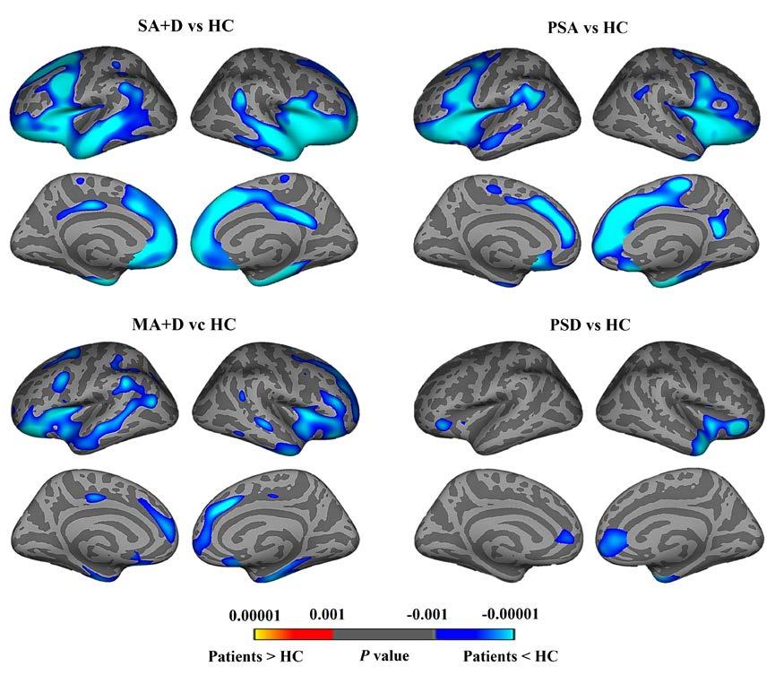 O Connor 8 Figure e-2: Patterns of brain atrophy in bvftd clusters vs healthy controls PSA = Primary severe apathy, SA+D = Severe apathy and disinhibition, MA+D = Mild