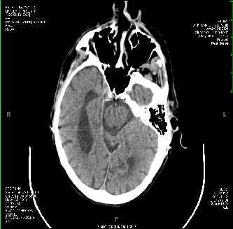 Case 1 Hospital Course Due to advanced age and outside extended time window patient determined not a tpa candidate Acute CTA no evidence of large clot (no intervention) Admitted to Neurology