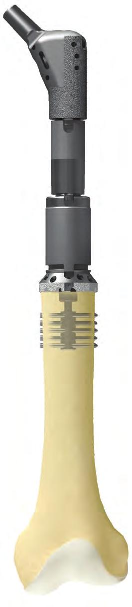 Finn-Style Proximal Femur (7 cm) OSS Small Head / Small Thread Locking Screw 5 cm OSS