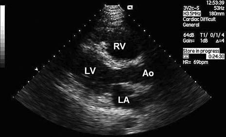 Radosław Kręcki et al., Arrhytmogenic right ventricular cardiomyopathy/dysplasia Figure 2.