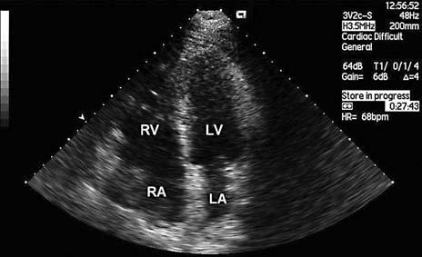 Parasternal long-axis view showing dilation of the right ventricle; RV right ventricle, LV left ventricle, LA left atrium, Ao aorta. Figure 4.