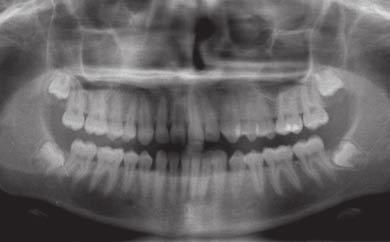 Figures 9a, 9b, 9c. The initial ClinCheck called for 26 upper aligners and 19 lower. Upper anterior interproximal reduction was needed to correct the left-to-right anterior tooth size discrepancy.