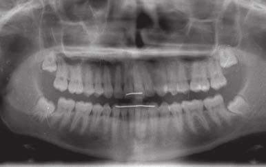 some time. The decision was made to obtain new impressions and do refi nement with beveled attachments to help control anterior tooth positions.