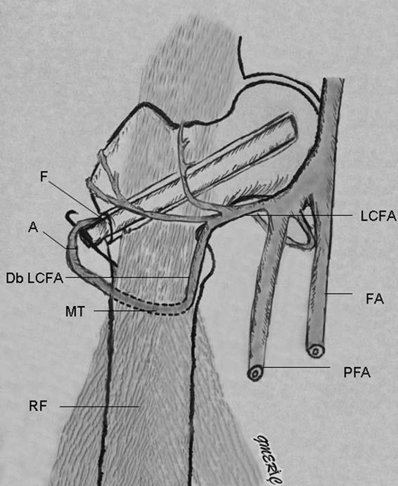(b) A saphenous vein graft may be harvested to complete the anastomosis proximally to the VFG vessels (FA: femoral artery, PFA: profunda femoris artery, DbLCFA: descending branch of the lateral