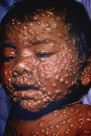 The Succes Story In 1979 smallpox was declared eradicated by WHO Only humans
