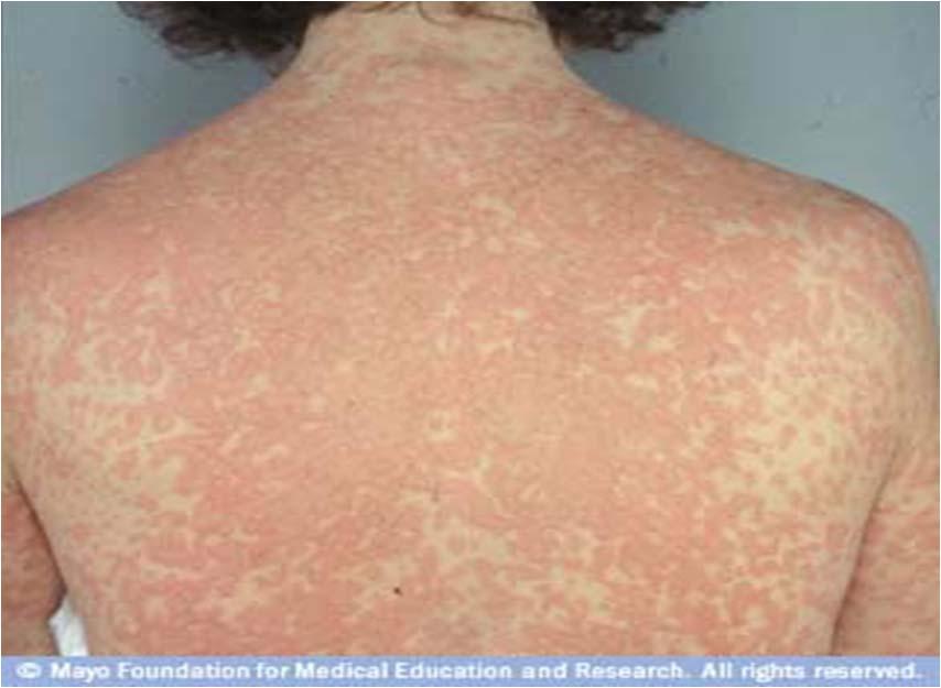 Rash is raised, reddish pin or salmon colored Begins on trunk and spreads to arms and legs Drug rash - Typical maculopapular rash Diabetic Skin Rashes Diabetics have more vulnerability to skin