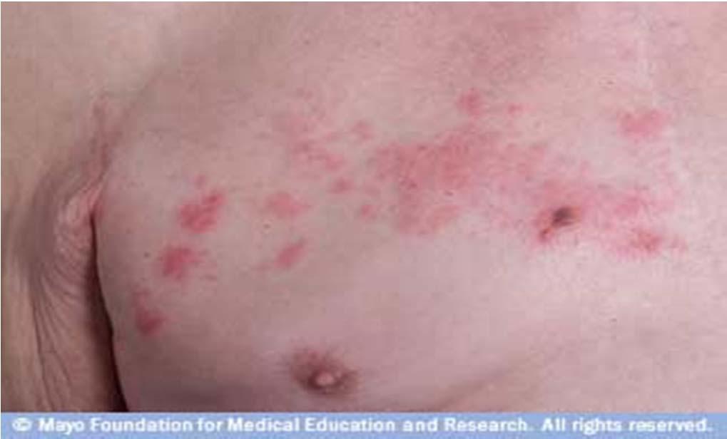 Shingles - Herpes Zoster Infection