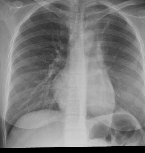 25 yo pregnant F CXR- left apical nodularity, scarring and volume loss which likely represent sequelae of old granulomatous disease.
