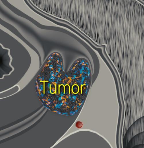 David Cibula, VFN Tumor detection Tumor size