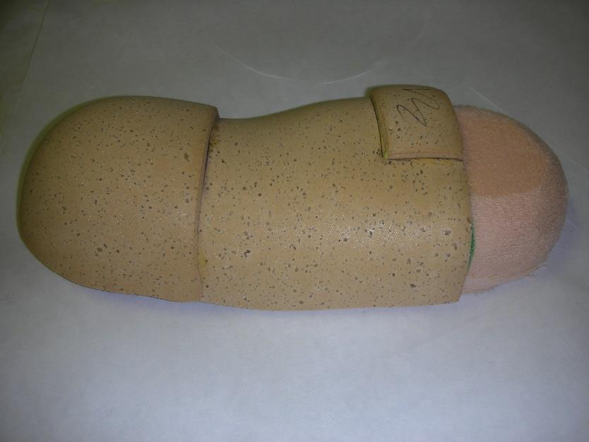 forefoot amputations by