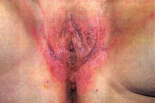 QUESTION #14 A 63-YEAR-OLD WOMAN, G 5 P 4014 REQUESTS EVALUATION BECAUSE OF A CHRONIC HISTORY OF VULVAR AND PERINEAL PRURITUS AND PAIN.