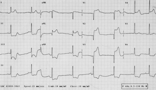 STEMI After Premature Discontinuation of