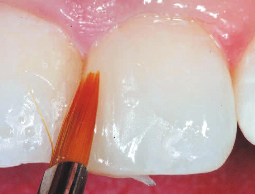 GRADIA DIRECT attains natural reflectivity through the use of a multifaceted tooth-like