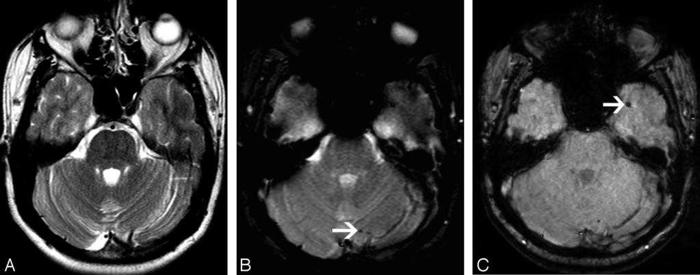 Fig 2. A 53-year-old female patient with familial CCM. A, Axial T2-weighted FSE image shows no significant abnormalities.