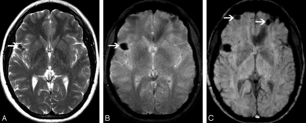 C, SWI demonstrates the cerebellar lesion but, in addition, shows a left temporal lesion (arrow), which was obscured by the bone artifacts. Fig 3. A 25-year-old female patient with familial CCM.