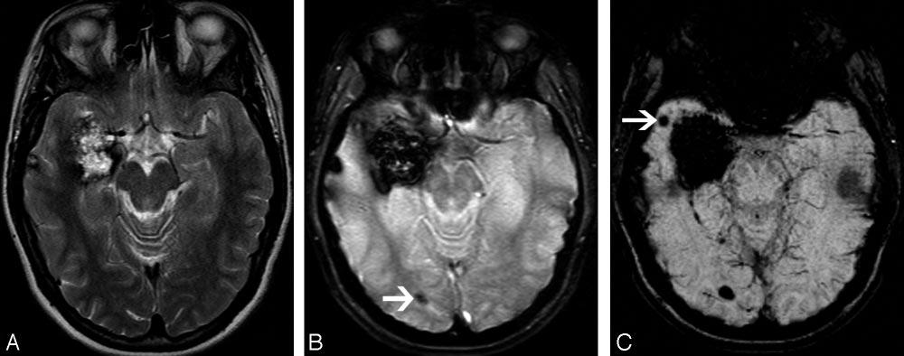 Fig 4. A 22-year-old female patient with familial CCM. A, Axial T2-weighted FSE image shows a large right temporal lesion with mixed signal intensity (type II).