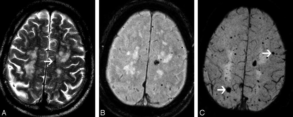C, SWI shows a small focus of low signal intensity on the right temporal region (arrow), which is dissociated from the large lesion (bloom effect). Fig 5. A 74-year-old male patient with familial CCM.