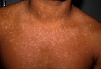 FIGURE NO.3: TINEA VERSICOLOR PATHOPHYSIOLOGY Two forms of the syndrome are recognized they are as follows: This type of syndrome shows multiple plane warts.