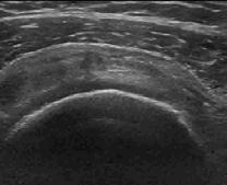 large, anterior supraspinatus tears 2 Ultrasound: Comparable to MRI 3 Improved reliability with extended