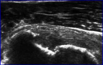 Partial-thickness Articular Tear: