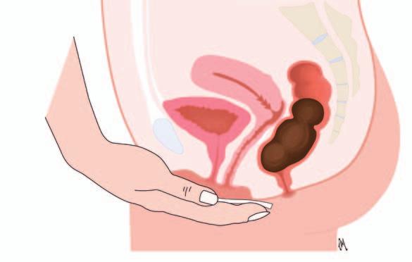 Moving your bowels It is important to avoid constipation as this puts extra unnecessary pressure on your pelvic floor muscles and operation site. Eating plenty of fruit, vegetables and fibre can help.