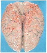 Brain with inflammatory exudate covering the