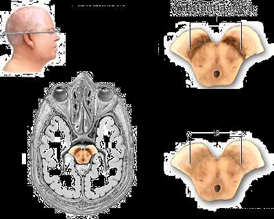 Parkinson brain Thalamus