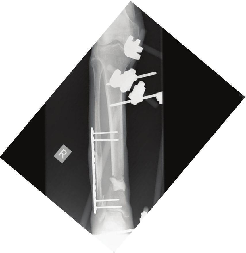 The Scientific World Journal 3 R Figure 2: AP lateral radiographs showing fixation with external fixator s placement of antibiotic cement spacer into the defect after the had been adequately debrided.