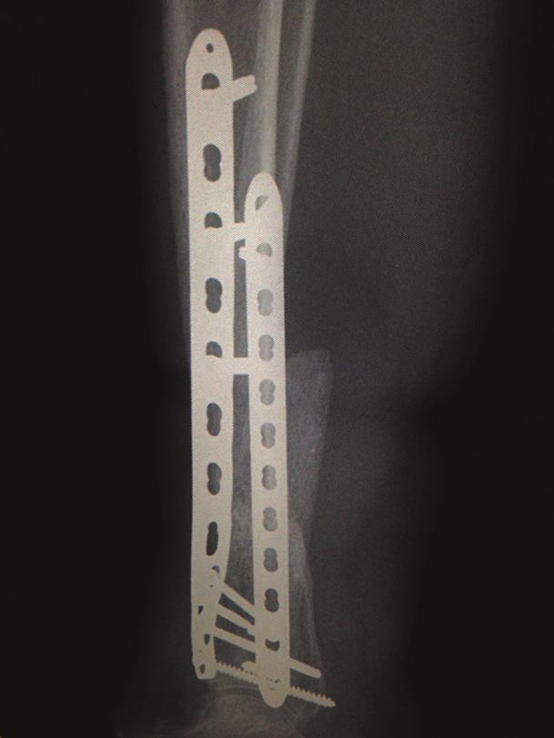 As mentioned, the technique has been used to address bone loss in areas other than long bones. Huffman et al.