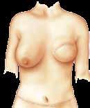Options for breast reconstruction surgery: With body tissue vs.