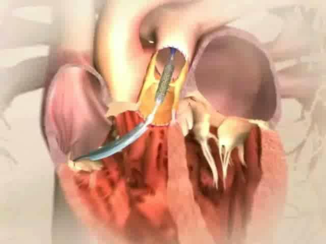 Transcatheter valve
