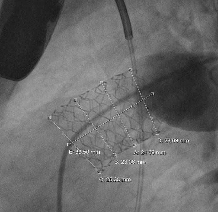 Native Outflow Tract and Transannular Patch