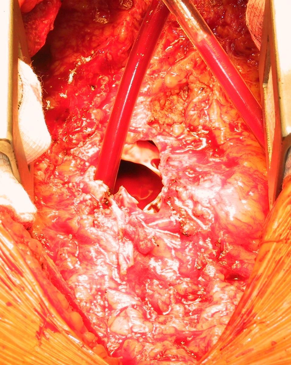 Transcatheter valve replacement Risks of surgical pulmonary valve