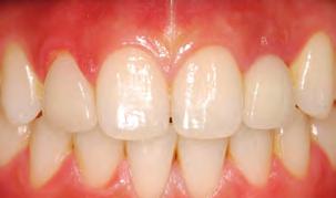 Implants feel more natural than removable partial or conventional complete dentures because of their secure fit.