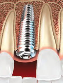 Bone and tissues grow around the implant.