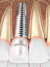 crown is placed on the implant.