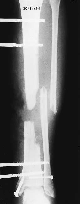 IPSILATERAL VASCULARISED FIBULAR TRANSPORT FOR MASSIVE DEFECTS OF THE TIBIA 1037 Fig.