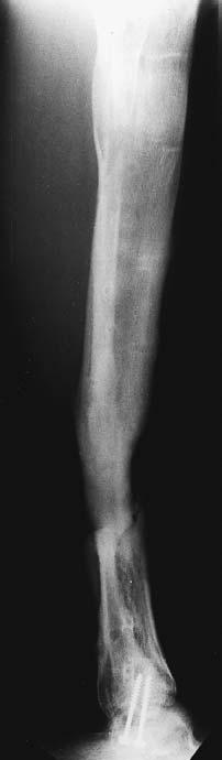 8 The vascular supply of the ipsilateral fibula is isolated as a loop and the bone is transposed into the defect as one or two segments.