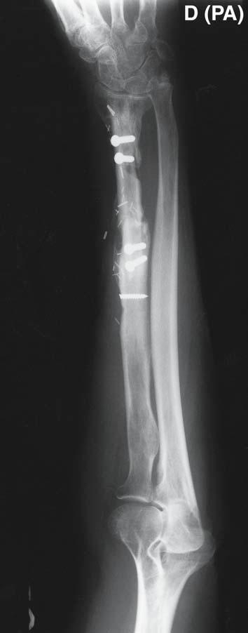 320 Gilbert and Wolfe Fig. 3. (D) At 4 mo postoperative there is full incorporation of the fibula proximally and distally, with no evidence of recurrence of the infection.