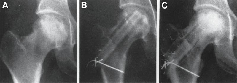 Vascularized Fibula Grafts 321 Fig. 4. Anteroposterior radiographs of the hip of a 35-yr-old woman who had stage III avascular necrosis of the femoral head.