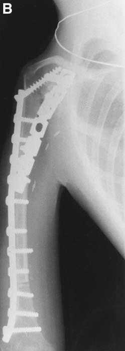 developed a nonunion of her glenohumeral joint after the resection of an