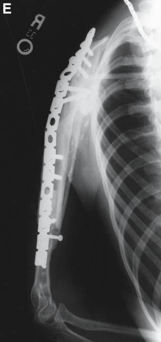 (E) Radiograph 2 yr postoperative demonstrating incorporation of the fibula graft and successful fusion of the shoulder joint.