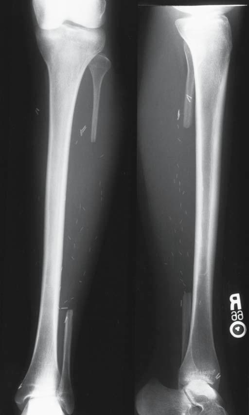 Vascularized Fibula Grafts 327 Fig. 7. Anteroposterior and lateral radiographs demostrating the osseous defect after vascularized fibula harvest.