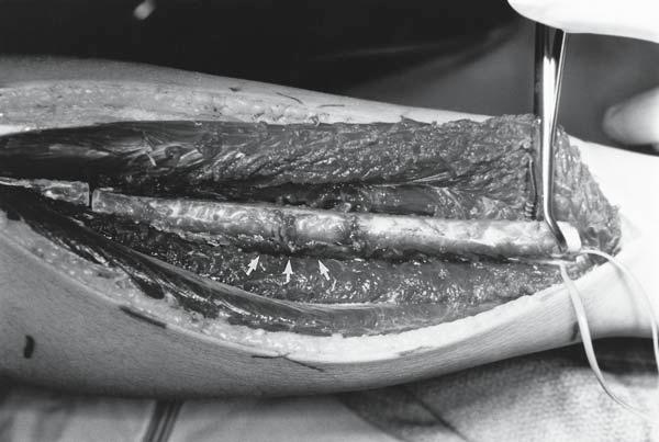 328 Gilbert and Wolfe Fig. 8. Intraoperative photograph demonstrating the vasularized fibula graft in its tissue bed after the proximal and distal osteotomies have been completed.
