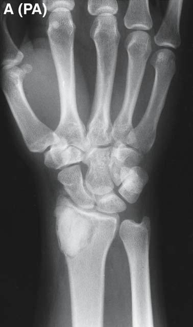 314 Gilbert and Wolfe Fig. 2. Radiographs of the wrist of a 29-yr-old male with a recurrent giant cell tumor of the distal radius.