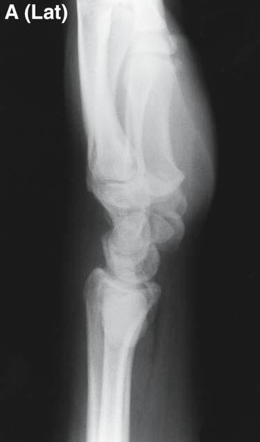 than 6 cm, conventional bone grafts are usually successful (1).